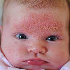 baby sick problem diaper rash or cradle cap